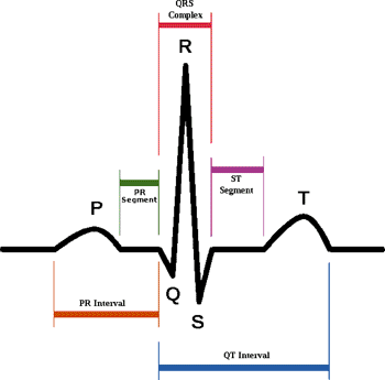 Imagen: En STEMI el segmento ST del ECG está elevado con respecto a la línea basal (Fotografía cortesía de Wikipedia.org).